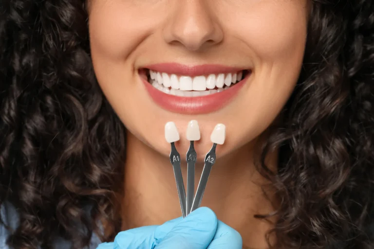 Porcelain Veneers