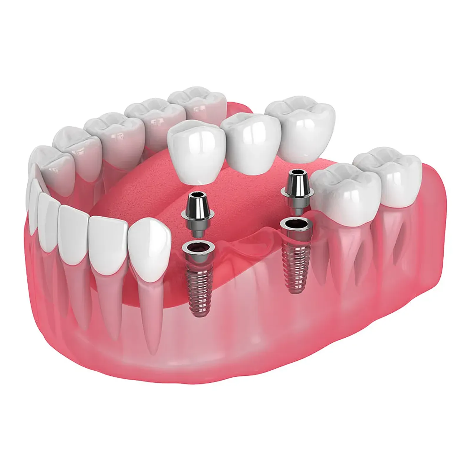 Implant-supported bridge