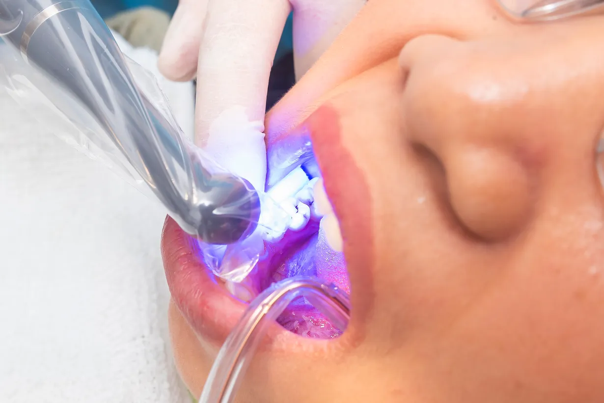 A bright, natural-looking smile after dental bonding