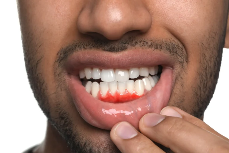 Gum Depigmentation