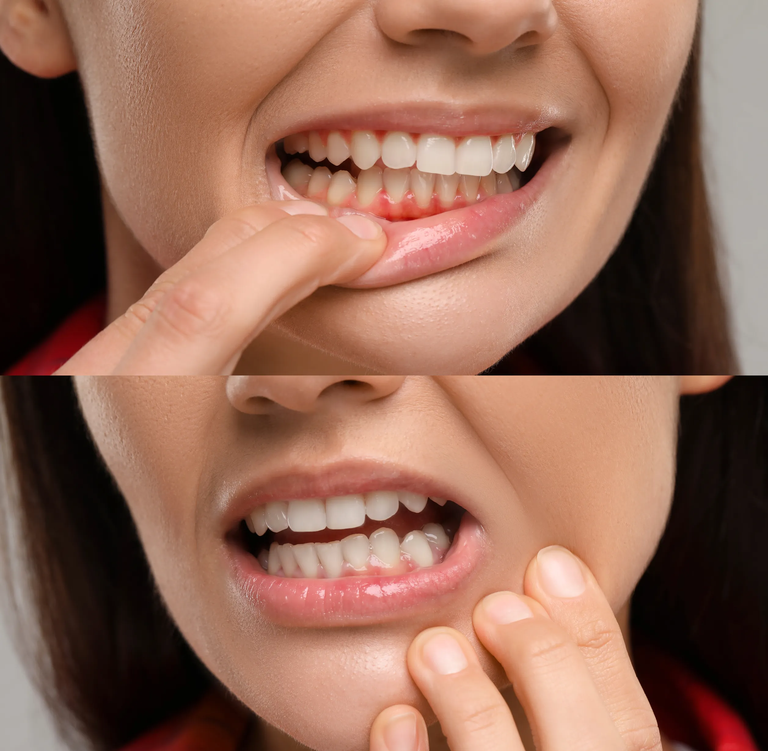 An even, healthy-looking gumline after gum depigmentation
