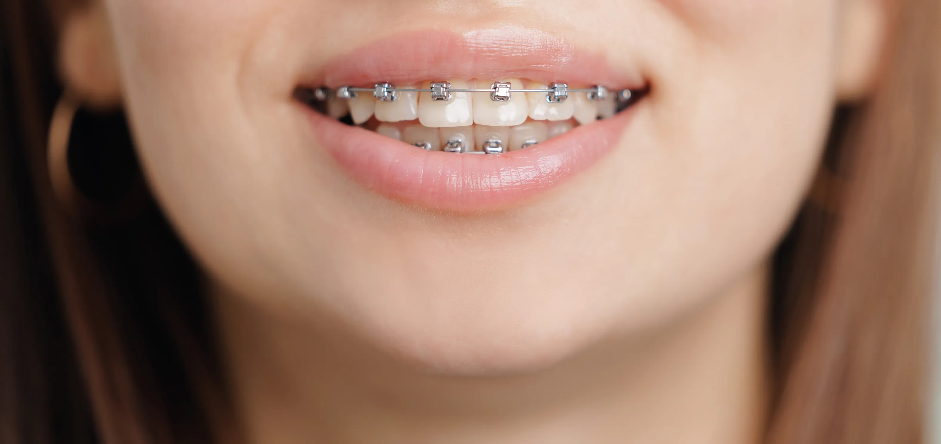 Close-up of traditional braces on a healthy smile
