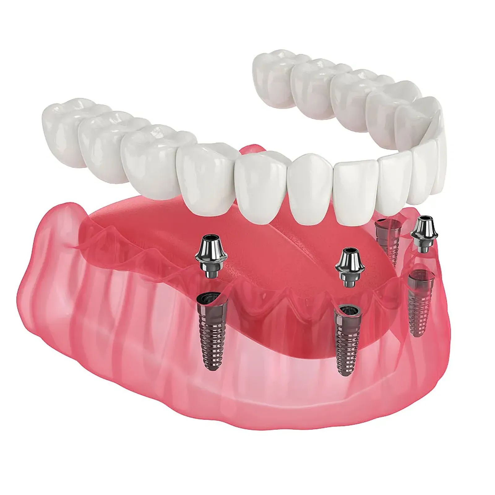 Full-arch dental implants