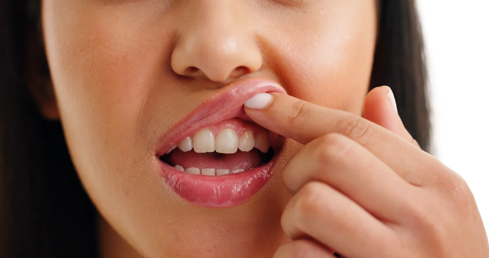 A healthy gumline after a gingivectomy