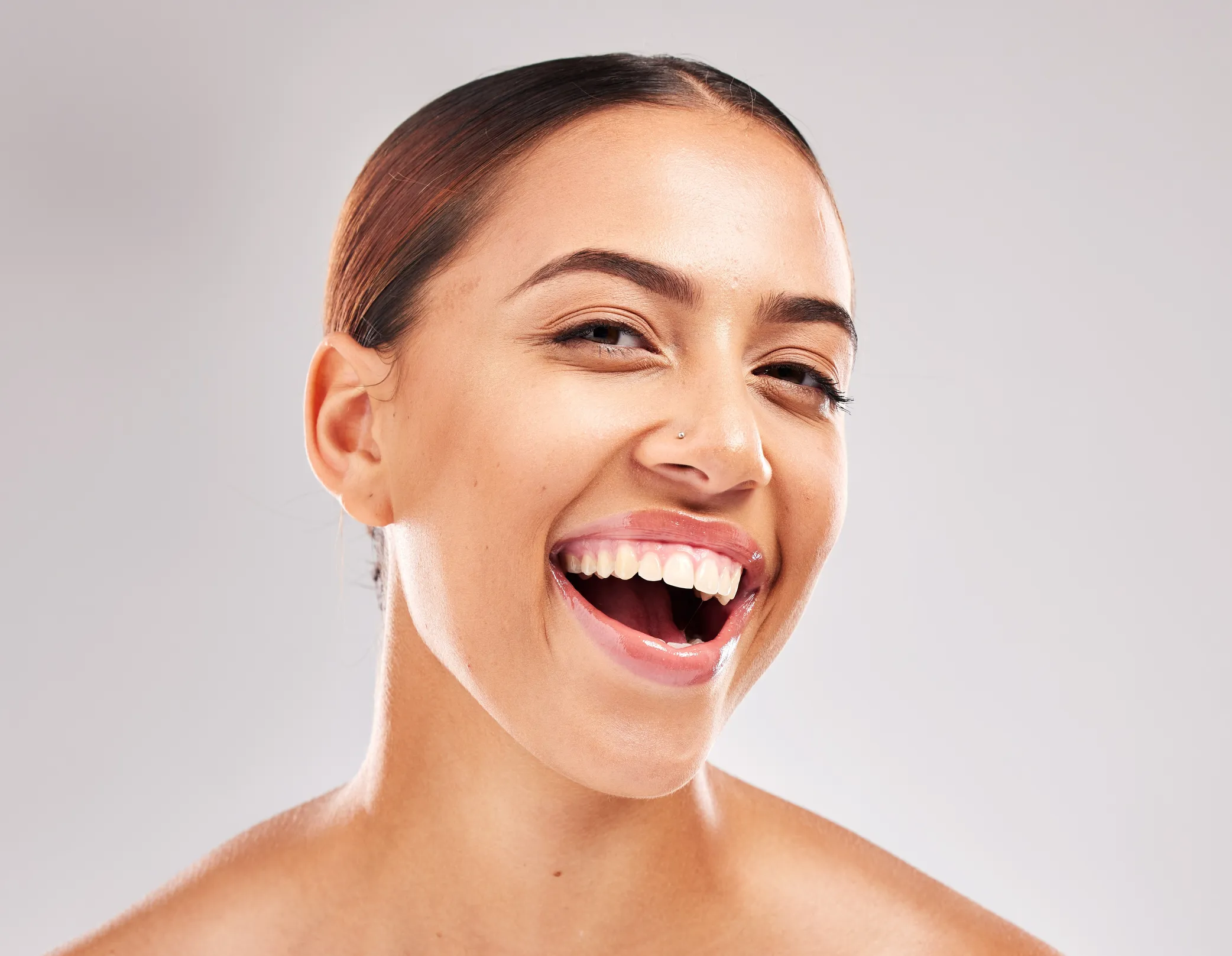 A balanced, even smile after gum contouring
