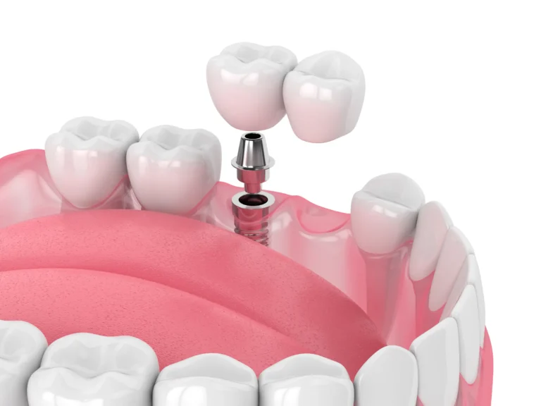 Dental Implants