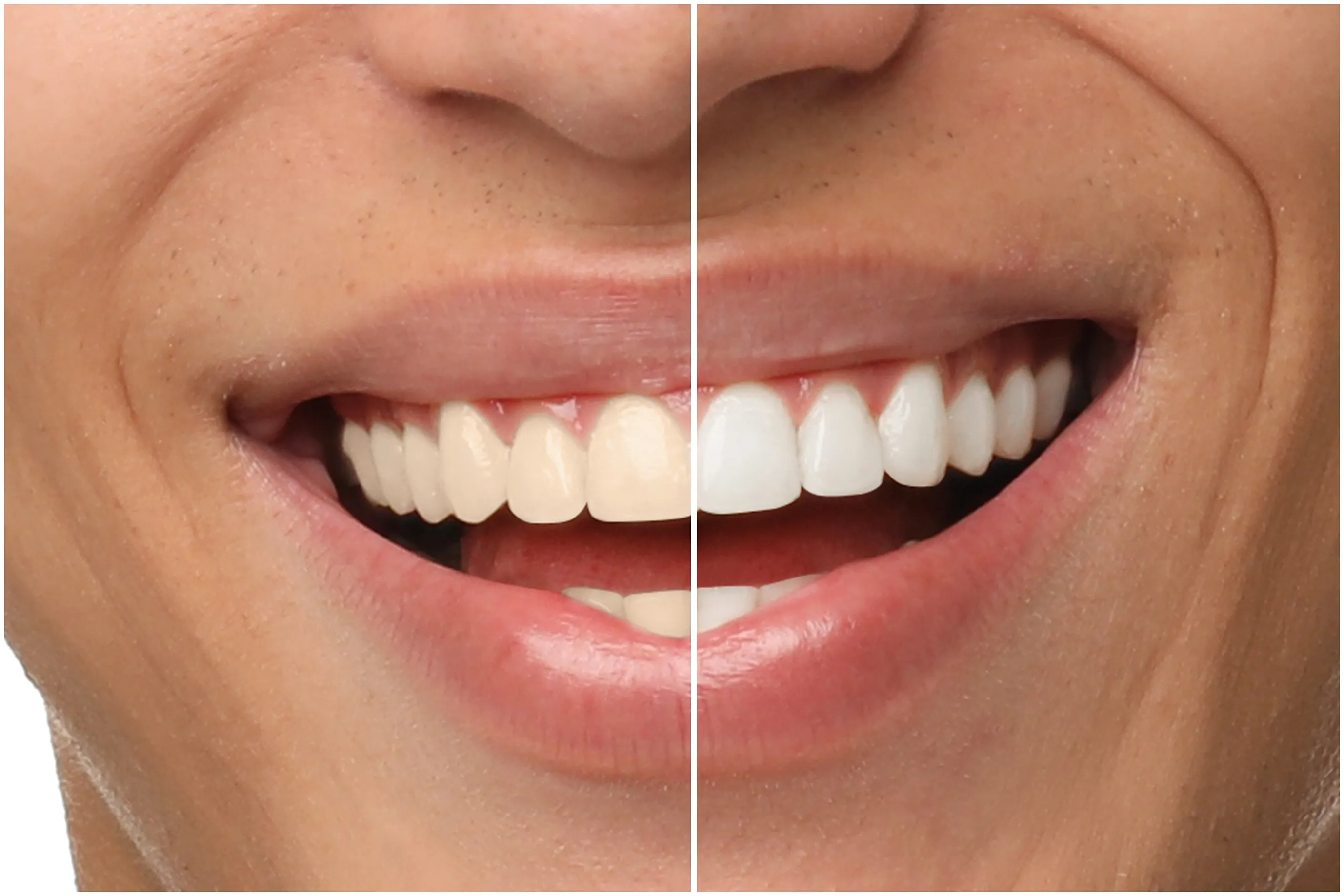 A bright, white smile after professional teeth whitening